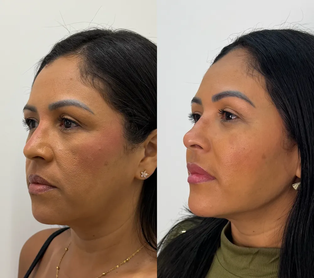 Antes e depois de paciente da Dra. Samara Câmara