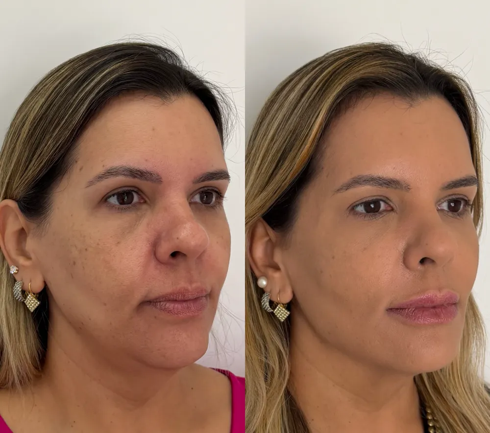 Antes e depois de paciente da Dra. Samara Câmara