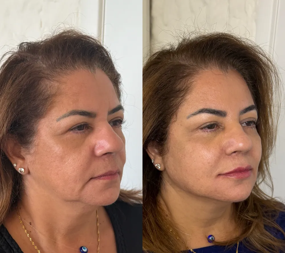 Antes e depois de paciente da Dra. Samara Câmara