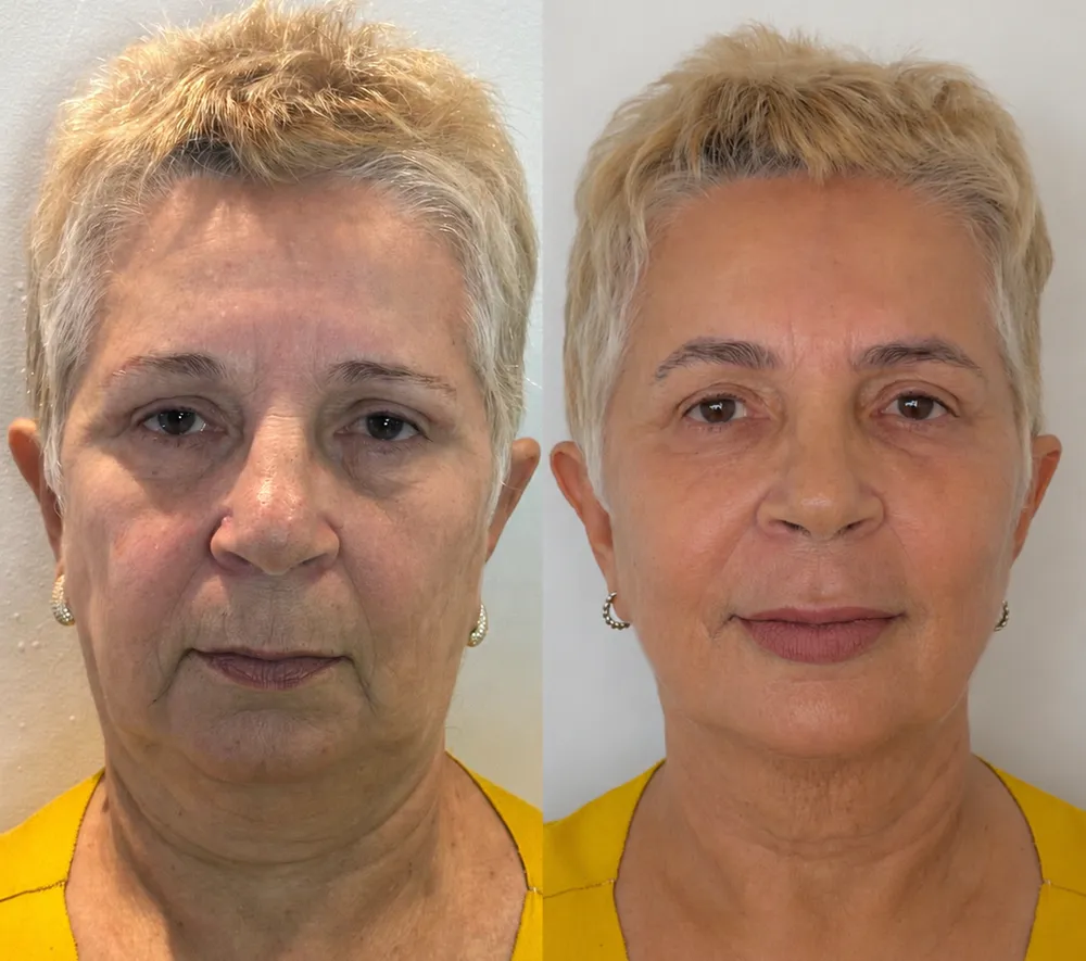 Antes e depois de paciente da Dra. Samara Câmara